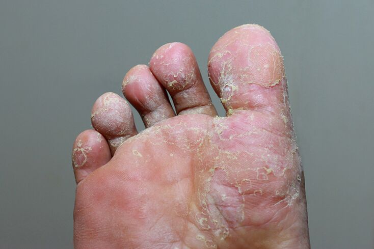 etapa severa de micosis de la piel de los dedos de los pies