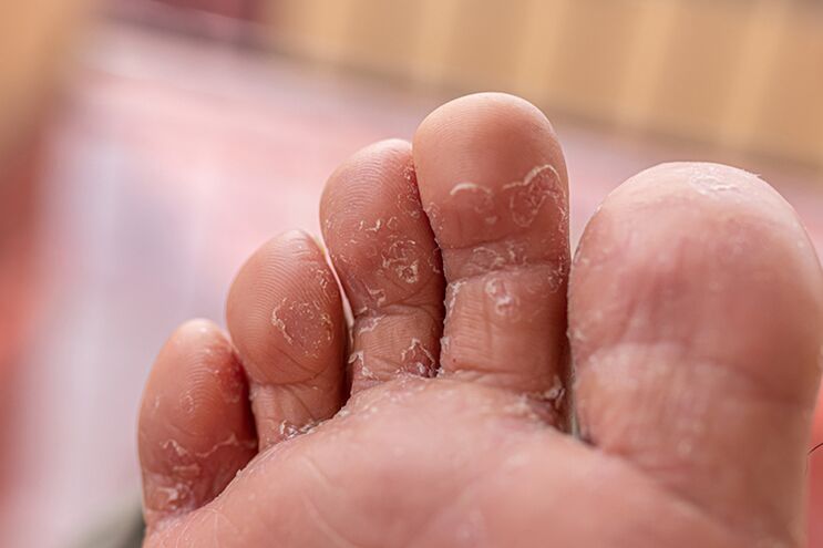 hongo de la piel de los dedos - la etapa inicial