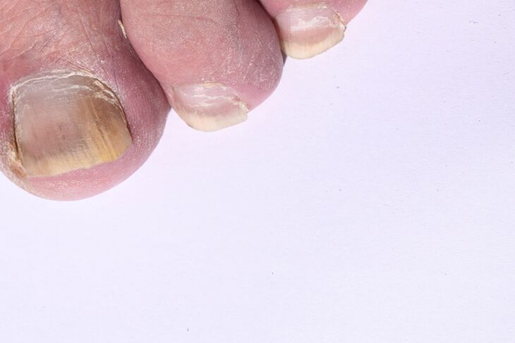 la etapa inicial de la micosis de las uñas de los pies