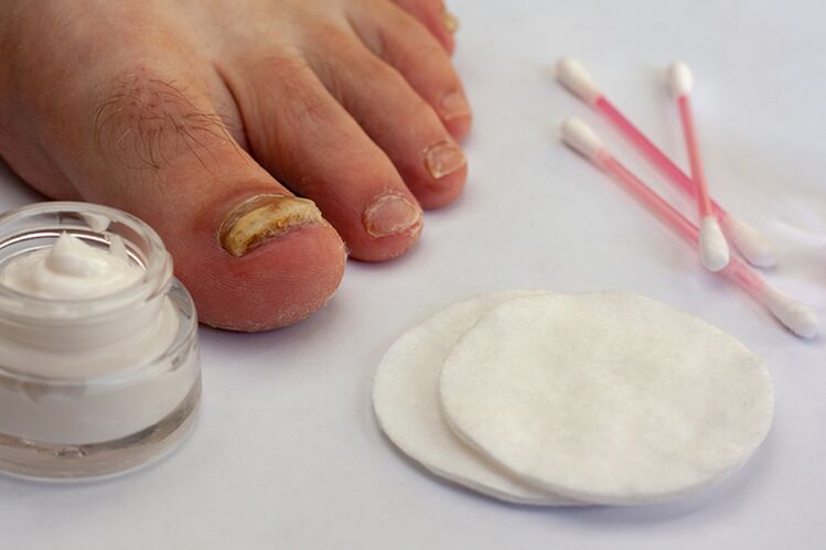 tratamiento de hongos en los dedos del pie con crema para hongos