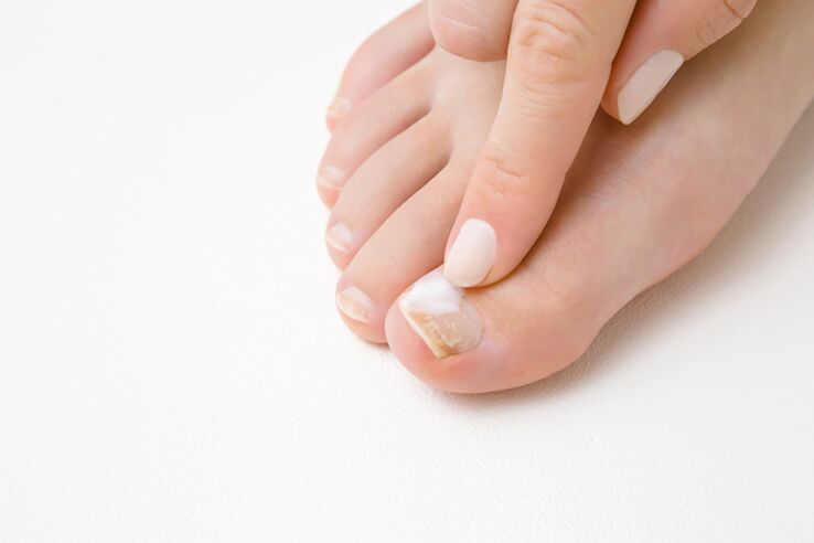 tratamiento de los dedos de los pies con ungüento para hongos