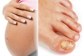 El embarazo y los hongos en las uñas de los pies