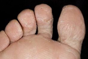 síntomas de hongos en la piel de los pies