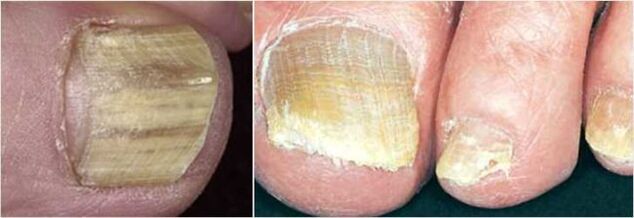 Forma avanzada de hongos en las uñas de los pies