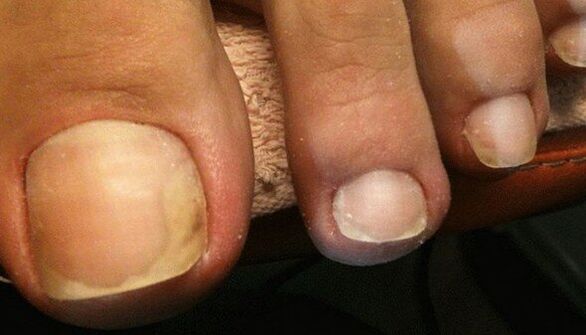 Signos de la etapa inicial de hongos en las uñas de los pies. 