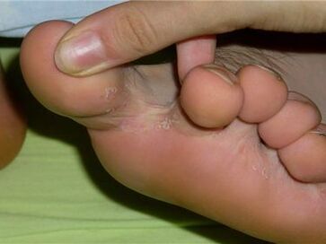 hongos entre los dedos de los pies