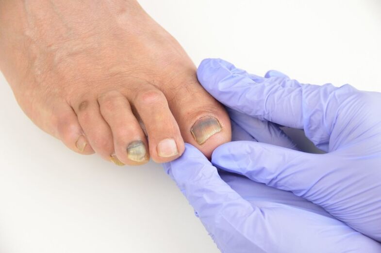 Examen médico de las uñas de los pies afectadas por un hongo