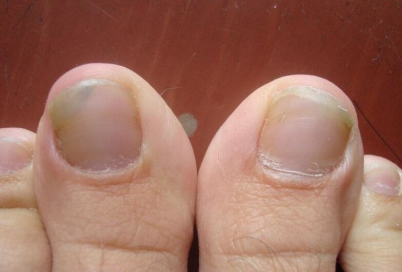 La etapa inicial de hongos en las uñas de los pies. 