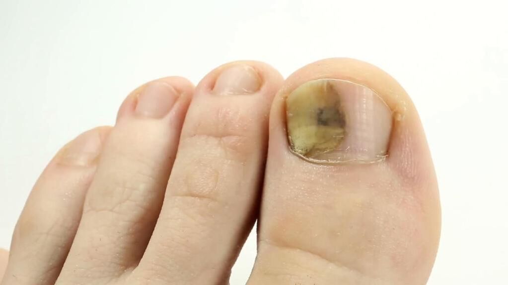 Aspecto de una uña del pie afectada por hongos